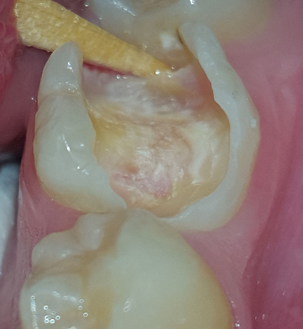 A tooth with a large cavity that was treated with Biomimetic dentist, Dr. David Hakham, who avoided a root canal on this tooth