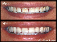 Before and after porcelain veneers improving smile balance near Montebello and Los Angeles, CA.