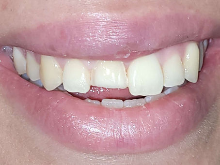 How to Save Broken Porcelain Veneers without a Crown: A Patient’s Journey