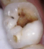 Tooth with large cavity to be treated with an emergency root canal in Los Angeles CA