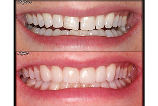 Before and after smile showing natural looking porcelain veneers
