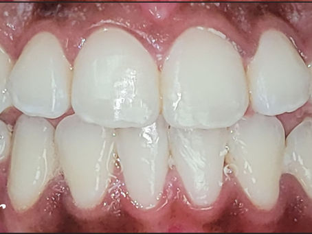 Gingivectomy: Correcting A Gummy Smile