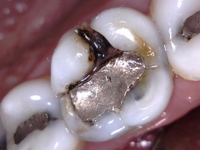Tooth with extensive cavity and fracture that needed to be extracted