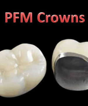 Porcelain Fused to Metal Crowns in Los Angeles CA