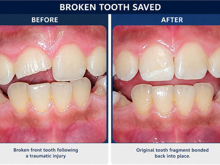 Before and after photos of a broken front tooth repaired using biomimetic dentistry by Dr. David Hakham in Montebello, California.