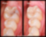 Before and After photographs of a tooth that was restored by biomimetic dentist in Montebello CA, Dr. David Hakham