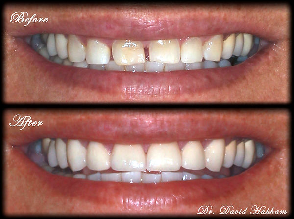 Veneers on Front Teeth Smile