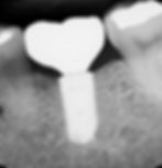Xray Image of a Dental Implant Placed by Dr. David Hakham, Dentist in Montebello for replacement of a missing Tooth