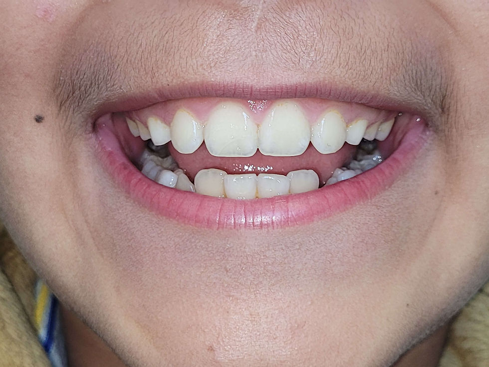 Patient smiling after conservative repair of a broken front tooth using the original tooth fragment.