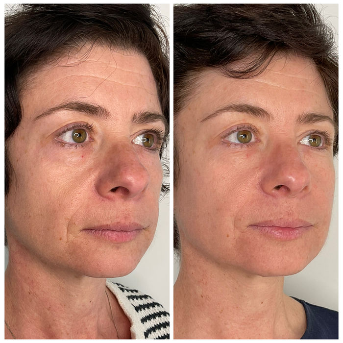 Angled before-and-after comparison of a client following Fotona 4D laser treatment.
