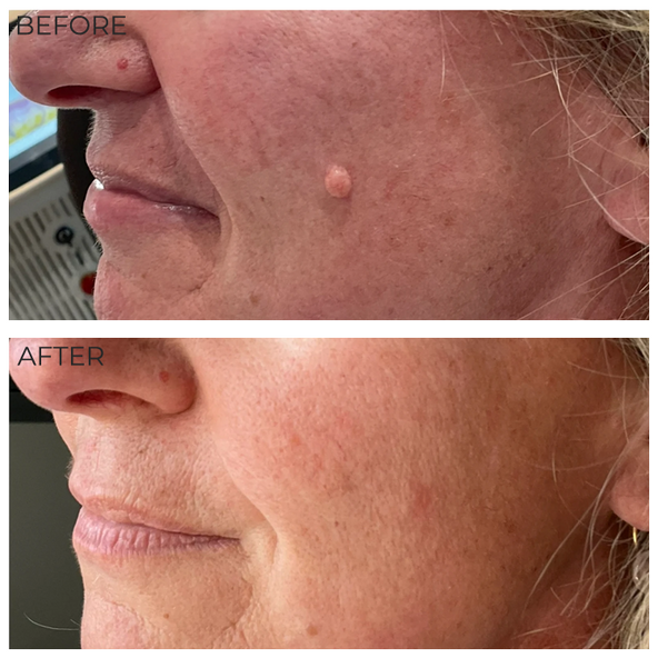 Before and after laser mole removal showing removal of a raised benign mole from the cheek.