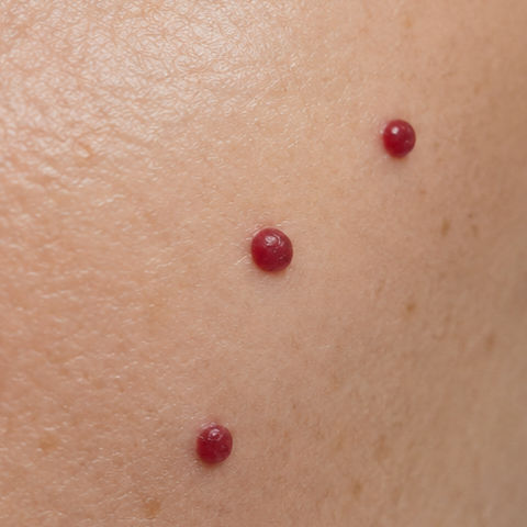 Close-up of three cherry angiomas on a person’s skin.