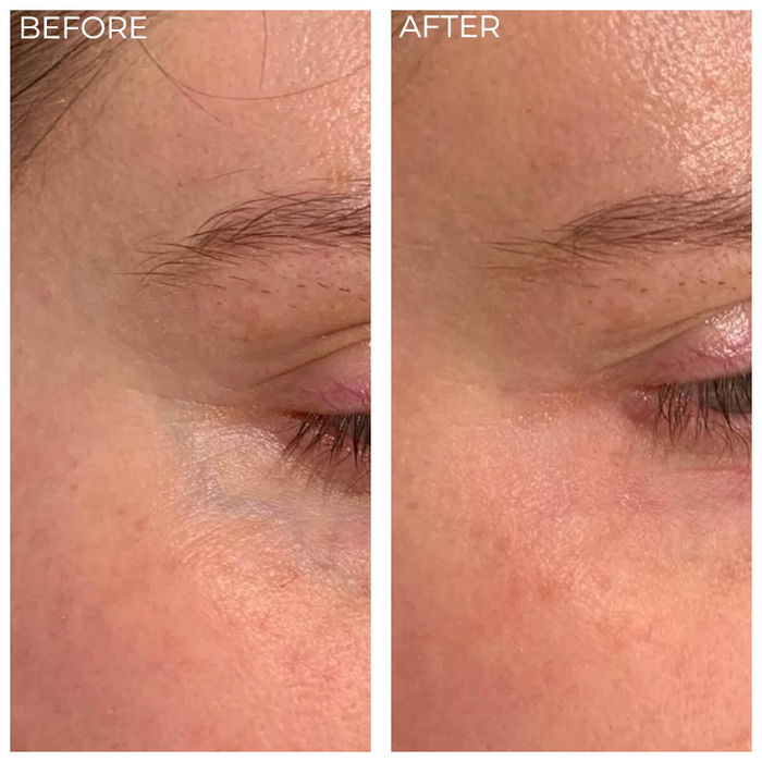 Before-and-after comparison of laser treatment for a fine vein beneath a client’s outer eye.