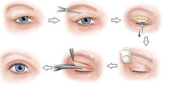 cắt mí mắt ở đâu đẹp hcm