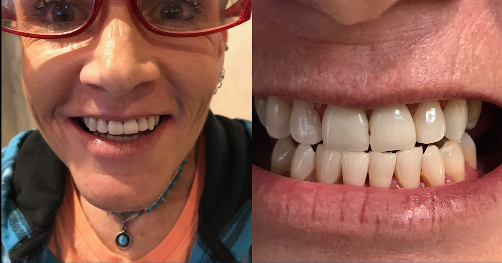 BEFORE & AFTER Best Implant Dentist Novato CA, David W Epstein DDS