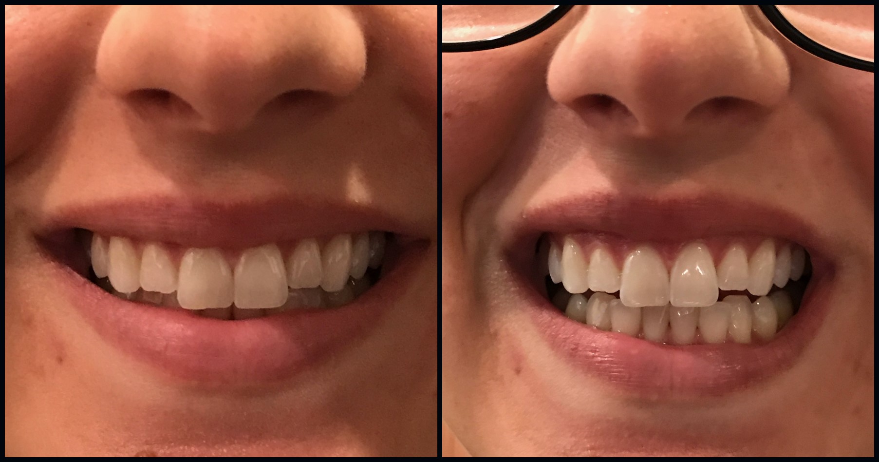 Best Implant Dentist Novato CA, David W Epstein DDS, (415) 8976453