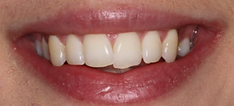 before teeth straightening