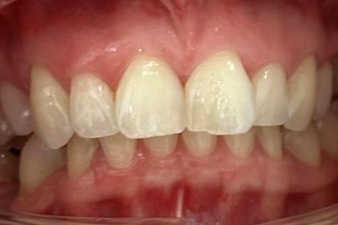 Belle Vue Dental Practice, South Benfleet, Essex SS7 1NA. Family, cosmetic and Invisalign dentistry since 1988.