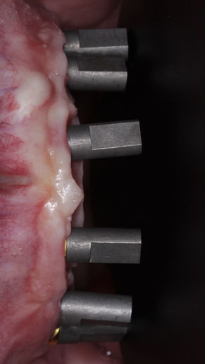implantes dentales cirugia dental carga inmediata