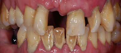 periodontitis clinica dental madrid leganes