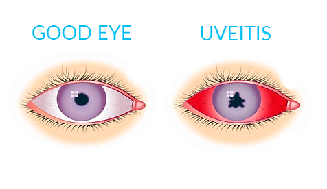 uveitis.png