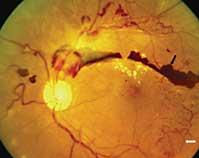retinopati9.jpg