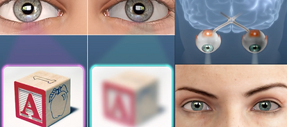 Brainerd+Eyecare+Center+Amblyopia.png