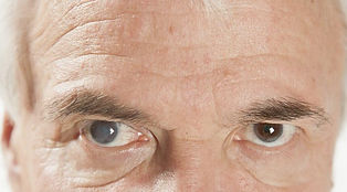 cataract.jpg
