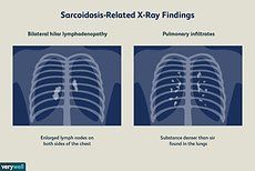 sarcoidosis-symptoms-treatment-2861011-color-V1-b49ac282e99d4e64b318783bbf89cb1a.png