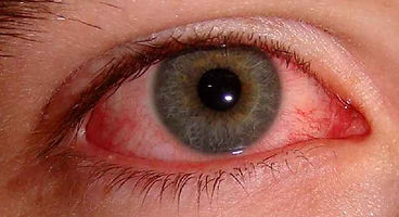 Retinopati-Diabetik.jpg