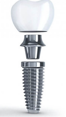 Dental Implant Exploded View.png