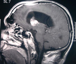 tumore endoventricolare.jpg