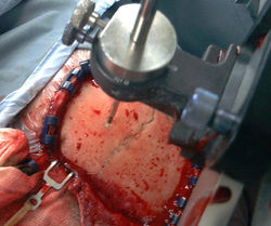 puntamento stereoguidato.jpg