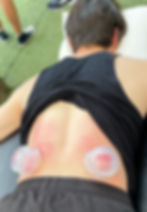 cupping therapy placed on a person's lower back