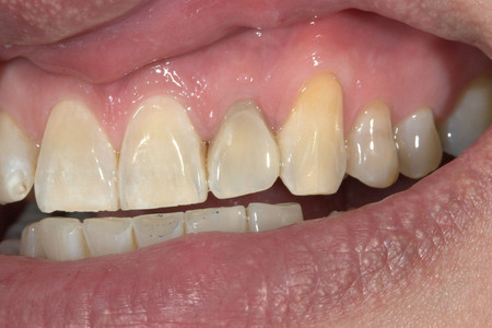 Emergency composite veneer treatment for a damaged front tooth at SOL Dental Arts, Maspeth Queens — case photo 1