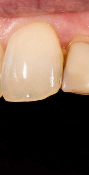 Before view of failing front-tooth bonding planned for composite veneer replacement in Maspeth Queens