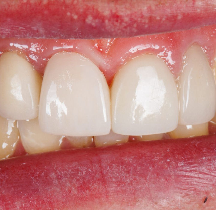 After treatment, close-up: the new front-tooth crown blending naturally with the surrounding teeth and gums.