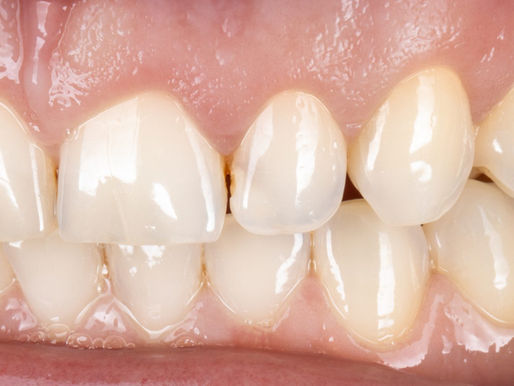 Catching a Cavity Between the Front Teeth: A Conservative, Tooth-Colored Repair