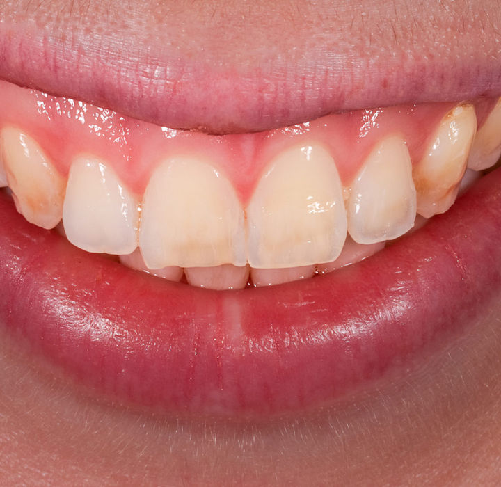 Discolored front teeth before conservative veneer bonding at SOL Dental Arts
