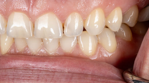 Chipped teeth cosmetic bonding repair before and after – Maspeth Queens dentist