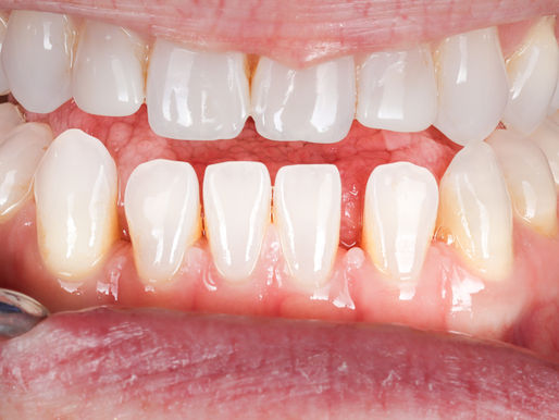 Black Triangles Between Your Teeth: Why They Form and How They're Closed Without Drilling