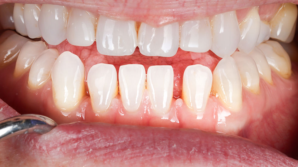 Closing “Black Triangles” Between the Lower Front Teeth with the Bioclear Method