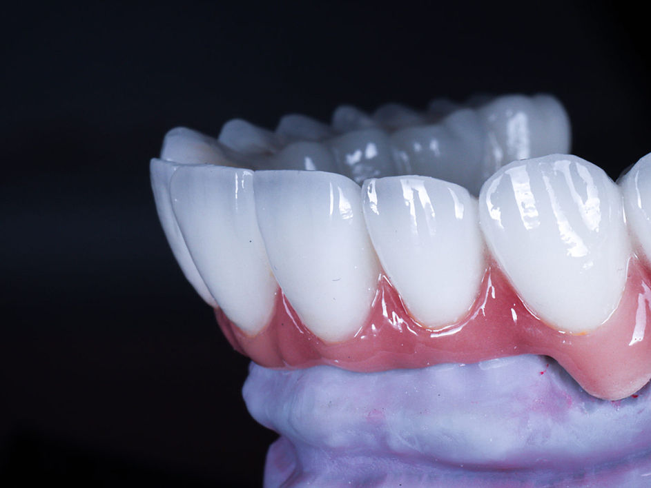 All-on-X implants full arch rehabilitation before and after — cosmetic dentistry case at SOL Dental Arts in Maspeth, Queens