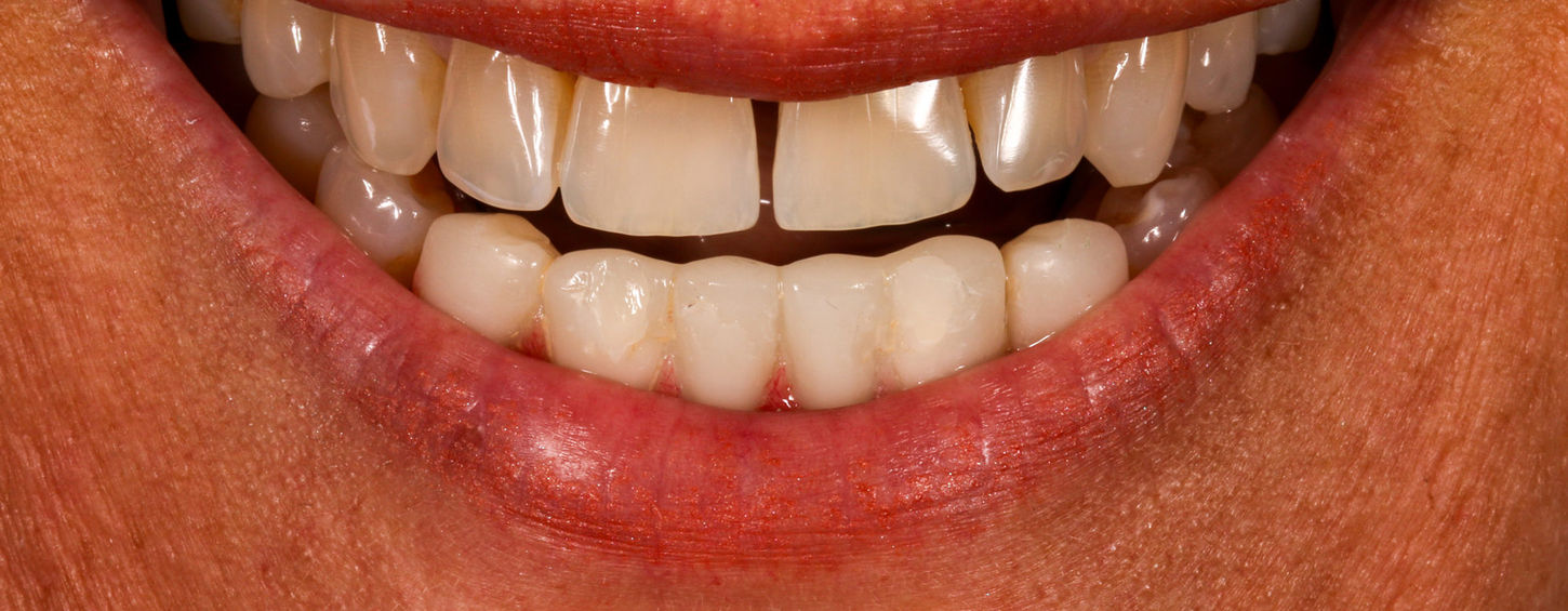 Smile refresh combining lower incisor cosmetic dentistry with implant bridge replacement — before and after at SOL Dental Arts