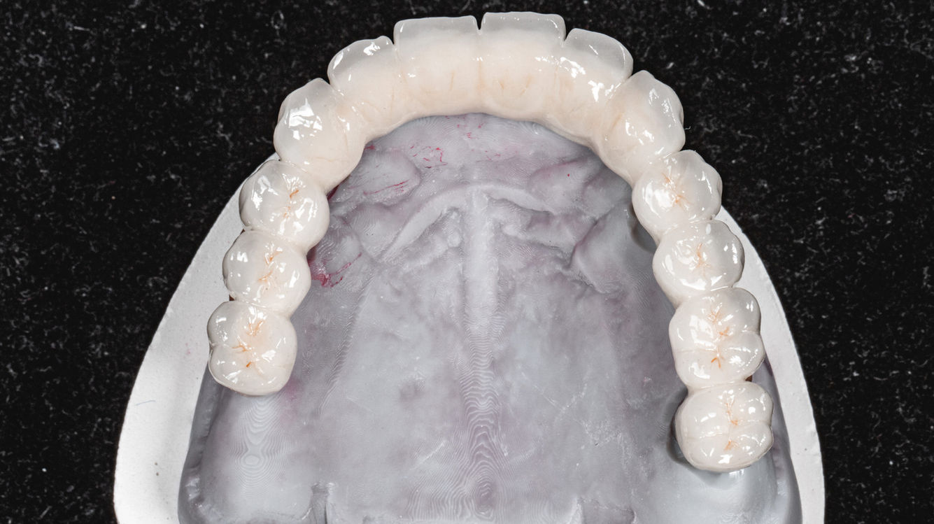Before and after full arch implant rehabilitation by SOL Dental Arts