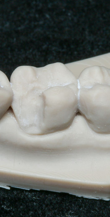Before partial-coverage crown or onlay case showing damaged posterior tooth structure in Maspeth Queens
