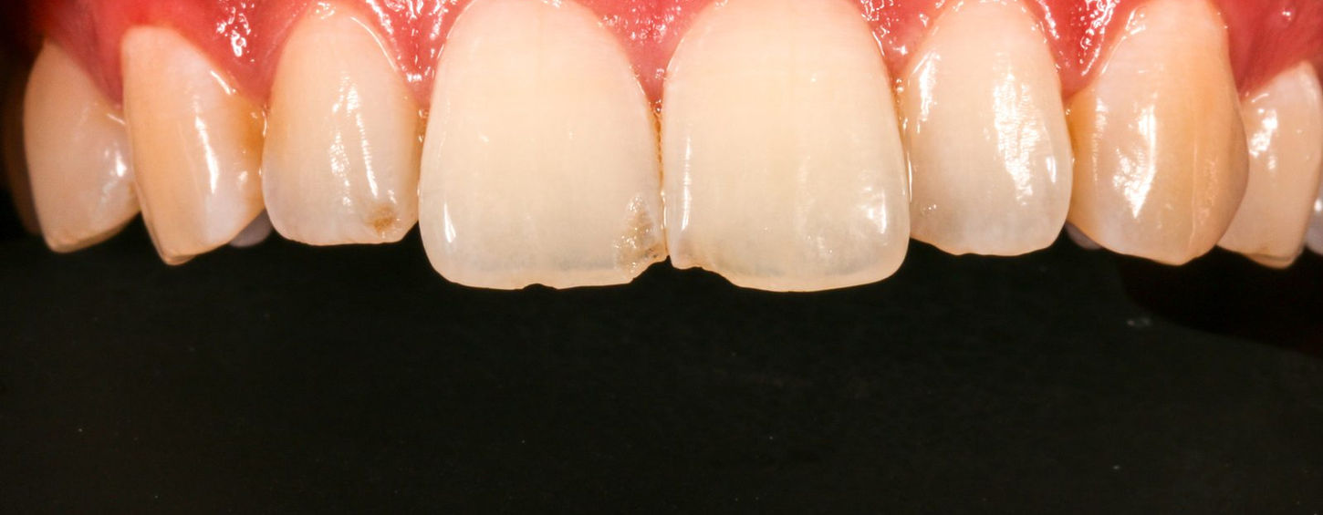 Before: trauma had fractured and shortened the corner of an upper central incisor, leaving the front teeth uneven.
