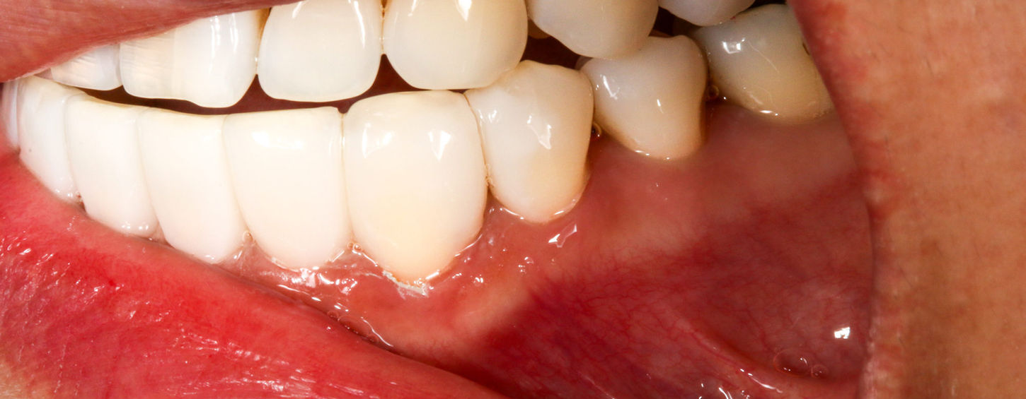 Completed Bioclear black triangle closure case in Queens