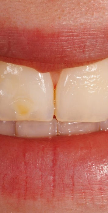 Before treatment, natural smile: a small chip and a yellow-brown spot on the upper right central incisor stand out in the smile line.