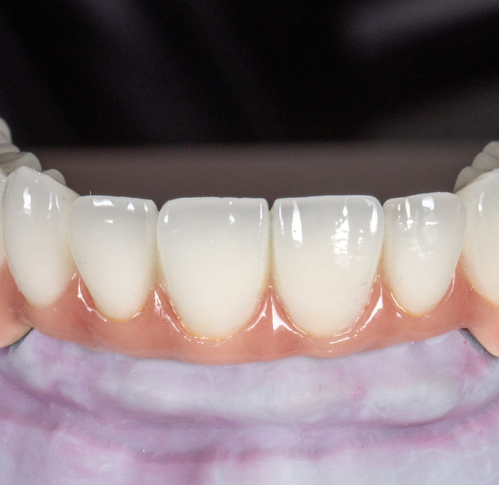 Completed full arch implant-supported smile rehabilitation at SOL Dental Arts